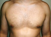 gynecomastia after photo