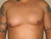 gynecomastia before photo