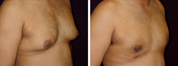 gynecomastia before & after photo