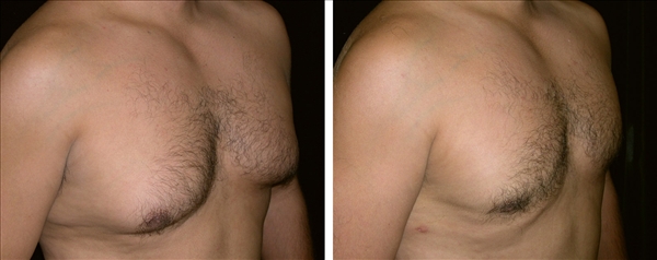 gynecomastia before & after photo