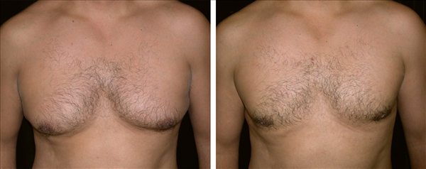 gynecomastia before & after photo