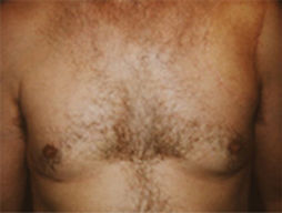 gynecomastia after photo