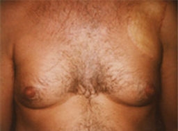 gynecomastia before photo