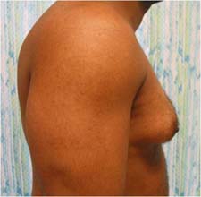 Photos Of Gynecomastia