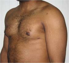 gynecomastia after photo