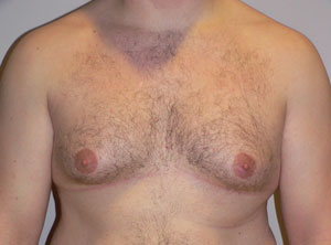 gynecomastia before photo