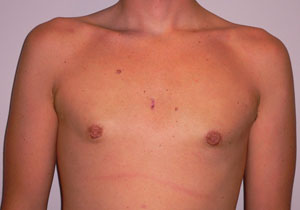 gynecomastia after photo