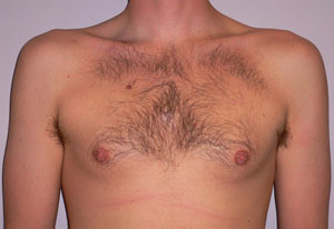 gynecomastia before photo