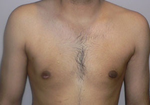 gynecomastia after photo