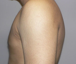 gynecomastia after photo