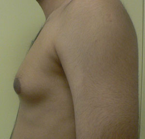 gynecomastia before photo