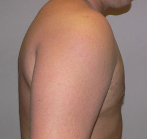 gynecomastia after photo