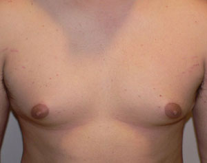 gynecomastia before photo