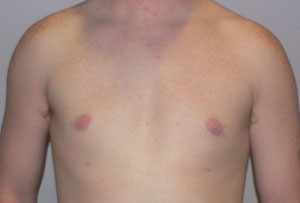 gynecomastia after photo