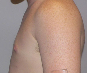 gynecomastia after photo