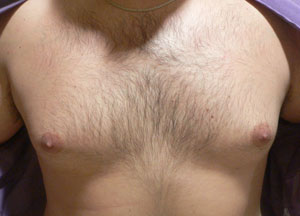 gynecomastia before photo