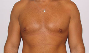 gynecomastia after photo