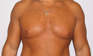 gynecomastia before photo